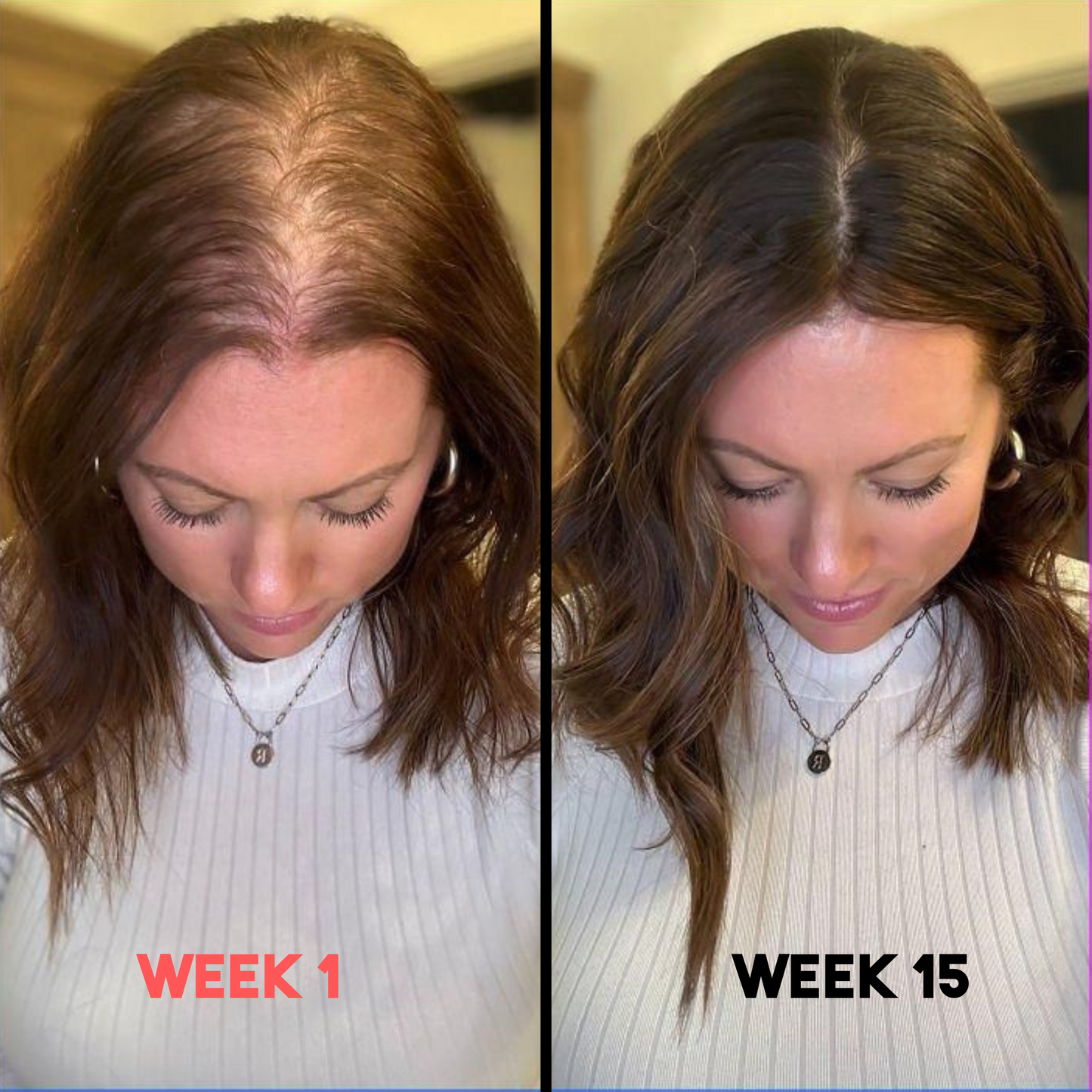 ReGrow X™ - Advanced Red Light Therapy for Postpartum Hairloss | Drug-Free, Safe & Natural