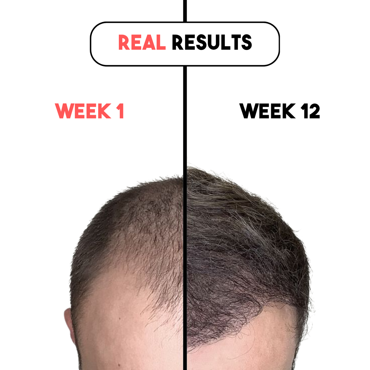 reGrow X™ - Advanced Red Light Therapy for Thicker, Fuller Hair – Naturally & Effortlessly